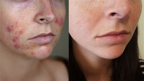 is 25 mg of spironolactone enough for acne|topical spironolactone before and after.